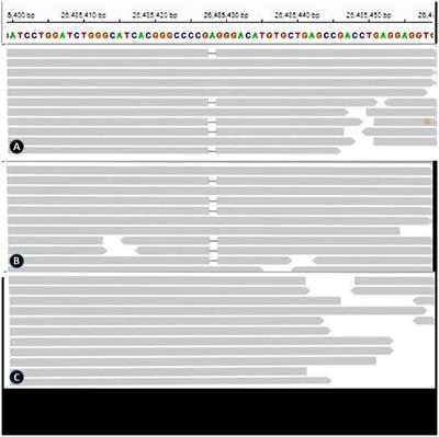 Clinical characteristics and genetic analysis of children with Omicron BF.7.14 type novel coronavirus-related acute necrotizing encephalopathy